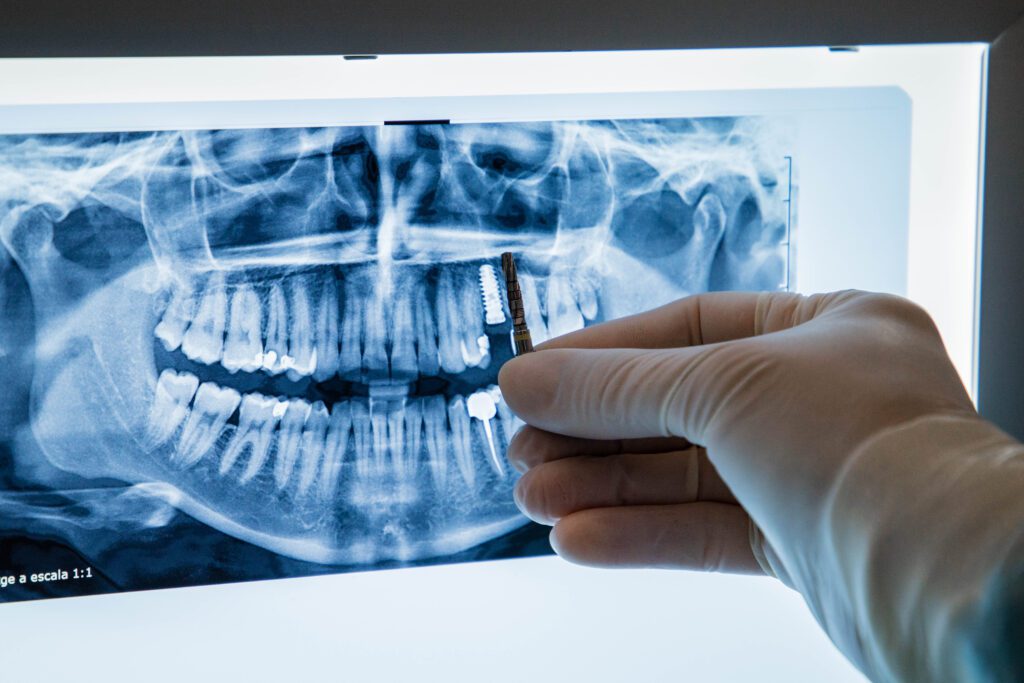 radiografie dentara cu implant dentar, radiografiile dentare nu sunt periculoase
