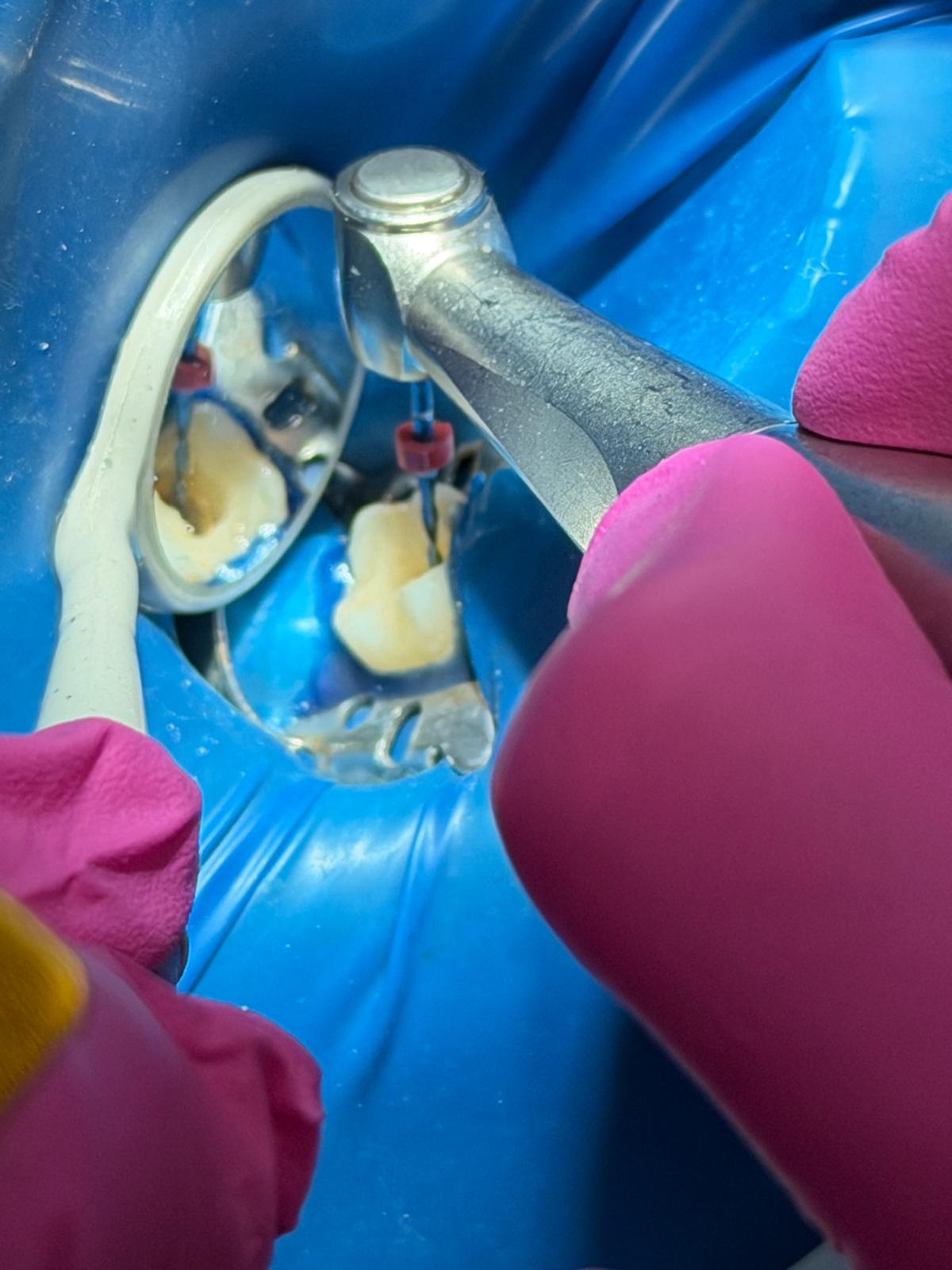 Tratament de canal cu izolare cu diga la Smile Dental Spa, Sector 4, București